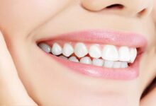 طراحی لبخند به چند روش و چگونه انجام میشود ؟ (2 نکته مهم)