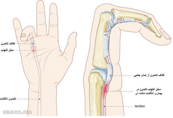  |آیا رباط همان تاندون است | فرق تاندون و رباط 