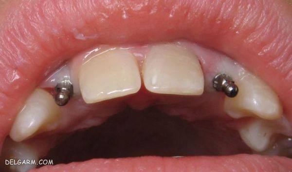 مینی ایمپلنت (mini implant) چیست و چگونه کاشته میشود ؟ (2 نکته مهم) هزینه مینی ایمپلنت | مینی ایمپلنت ارتودنسی | مینی ایمپلنت