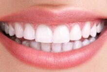 مینی ایمپلنت (mini implant) چیست و چگونه کاشته میشود ؟ (2 نکته مهم)