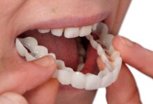 کاور دندان (snap on smile) چیست و چه کاربردی دارد ؟ (2 نکته مهم)