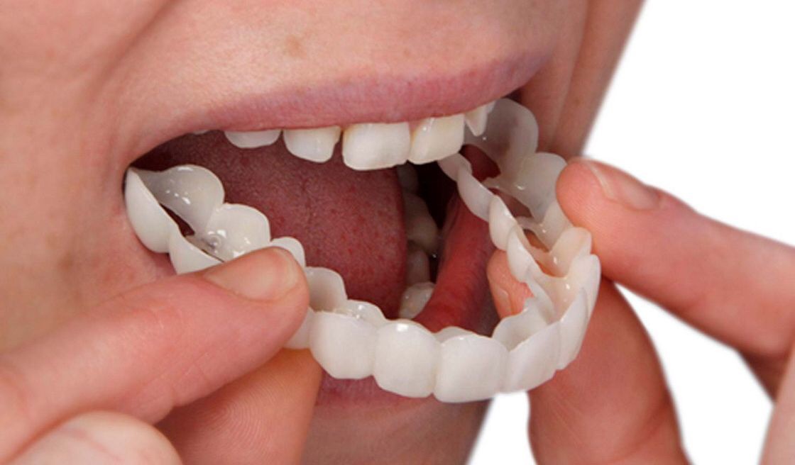 کاور دندان (snap on smile) چیست و چه کاربردی دارد ؟ (2 نکته مهم)