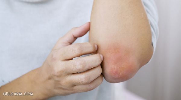 آلرژی به نارگیل
