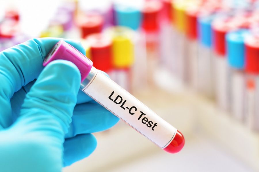 LDL در آزمایش خون : تفسیر کامل کلسترول بد (LDL) در آزمایش چیست ؟ (2 نکته مهم) LDL در آزمایش خون : تفسیر کامل کلسترول بد (LDL) در آزمایش چیست ؟ (2 نکته مهم)