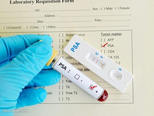 تفسیر آزمایش free psa در تشخیص سرطان پروستات