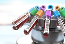 P-LCR در آزمایش خون و بررسی سطح آن در بیماری های مختلف (2 نکته مهم)