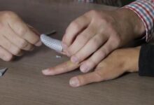راههای تشخیص و علائم شکستگی انگشت دست (2 نکته مهم)