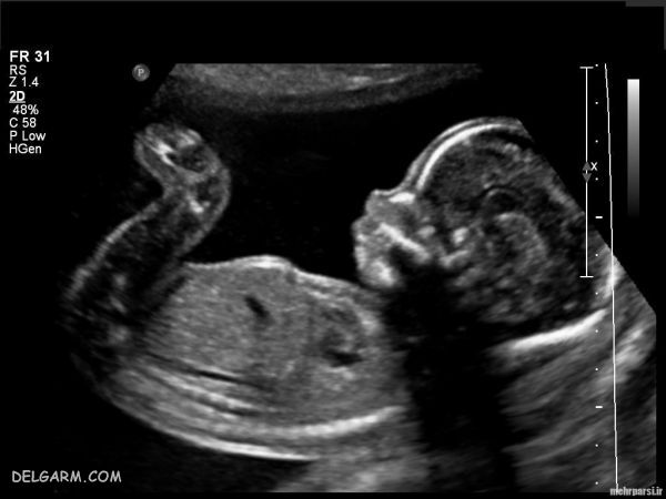 اصطلاحات سونوگرافی بارداری
