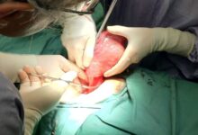 علت خونریزی بعد از جراحی هیسترکتومی چیست و چگونه درمان می شود ؟ (2 نکته مهم)