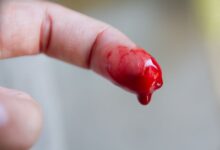 هنگام خونریزی یا قطع عضوی از بدن چه باید کرد ؟ (2 نکته مهم)