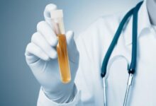 آزمایش وزن مخصوص ادرار | ‏Specific gravity در آزمایش ادرار چیست ؟ (2 نکته مهم)