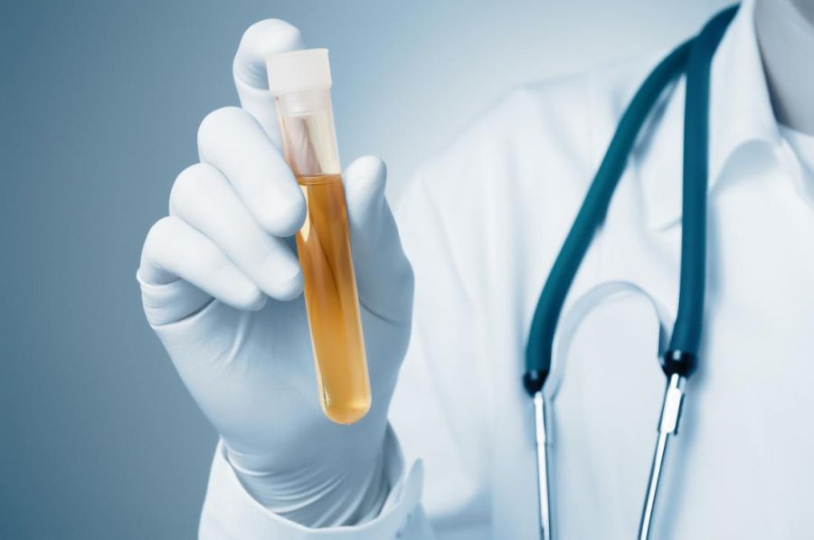 آزمایش وزن مخصوص ادرار | ‏Specific gravity در آزمایش ادرار چیست ؟ (2 نکته مهم)