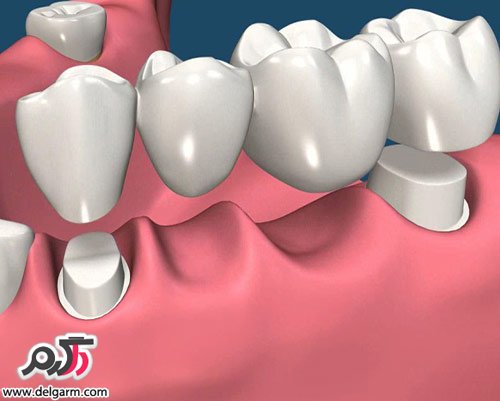 فواید روکش و بریج دندان
