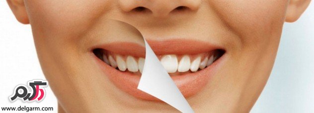 فواید روکش و بریج دندان (2 نکته مهم)