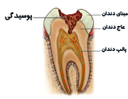پوسیدگی دندان بیماری شایع درکشور  (2 نکته مهم)