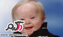 کودک، جنین، سندروم داون