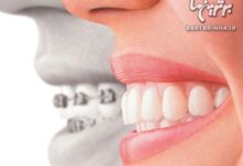آنچه که باید درباره ارتودنسی بدانید (2 نکته مهم)