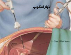 از لاپاروسکوپی یا جراحی باز چه میدانید ؟