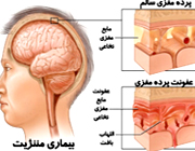 مغز هم ورم می‌کند
