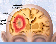مغز هم ورم می‌کند