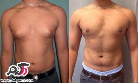 دلایل اصلی بزرگ شدن پستان مردانه (2 نکته مهم)