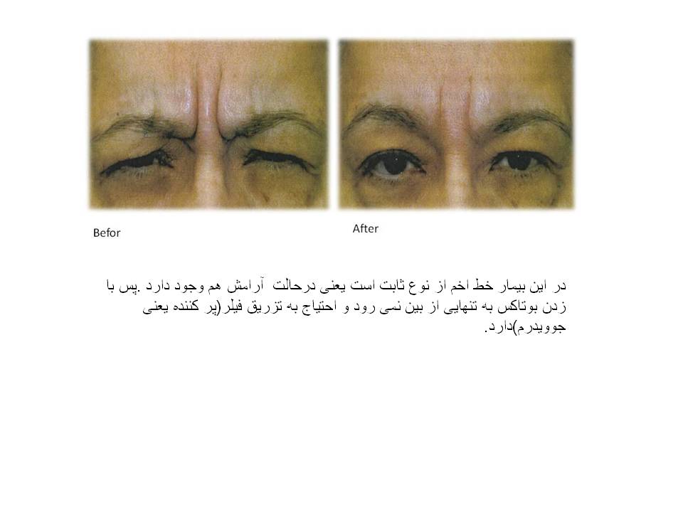 بوتاکس چیست و چه عوارضی دارد؟