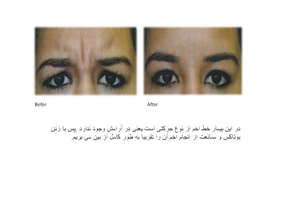بوتاکس چیست و چه عوارضی دارد؟