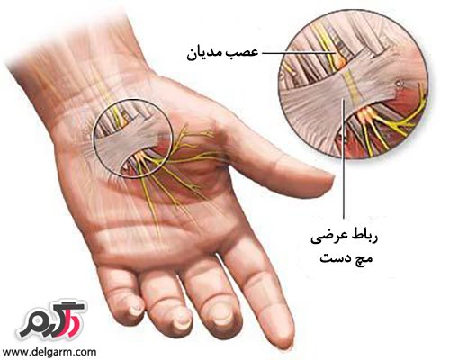 سندرم کانال کارپ (نشانگان تونل مچ دست)چیست؟