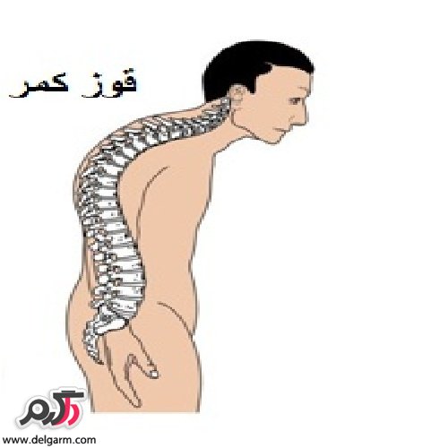 درمان قوز کمر (2 نکته مهم)