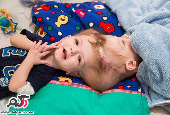 جراحی دو قلوهای بهم چسبیده