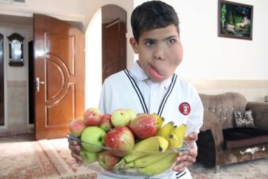 تنها آرزوی این پسربچه مداوای صورتش است