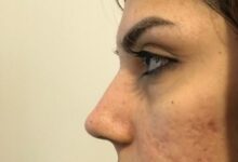 آیا واقعا پلاسما جت (پی آر پی) باعث کوچک شدن بینی می شود؟ (2 نکته مهم)