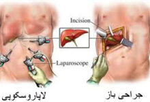 از لاپاروسکوپی یا جراحی باز چه میدانید ؟ (2 نکته مهم)