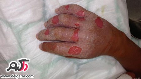 برطرف کردن جای سوختگی و تسکین درد سوختگی در خانه (2 نکته مهم)