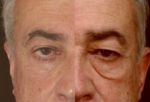 بلفاروپلاستی (جراحی پلک) چیست؟ چه عوارضی دارد؟ (2 نکته مهم)