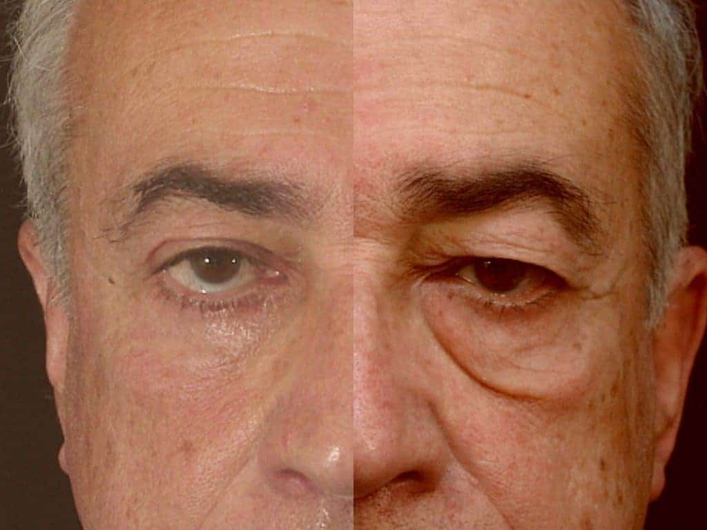 بلفاروپلاستی (جراحی پلک) چیست؟ چه عوارضی دارد؟ (2 نکته مهم)