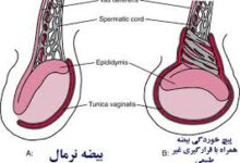 تاخیر در جراحی پیچش بیضه باعث از دست رفتن این عضو میشود (2 نکته مهم)