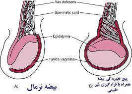 تاخیر در جراحی پیچش بیضه باعث از دست رفتن این عضو میشود (2 نکته مهم) تاخیر در جراحی پیچش بیضه باعث از دست رفتن این عضو میشود (2 نکته مهم)