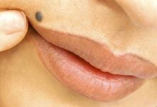 راه های سنتی و طبیعی را برای از بین بردن خال امتحان کنید (2 نکته مهم)