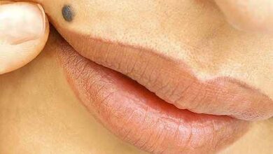 راه های سنتی و طبیعی را برای از بین بردن خال امتحان کنید (2 نکته مهم)