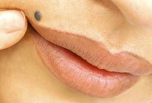 راه های سنتی و طبیعی را برای از بین بردن خال امتحان کنید (2 نکته مهم)