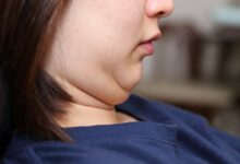رژیم دکتر کرمانی: چگونه چاق شدن صورت را به حداقل برسانیم؟ (2 نکته مهم)