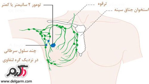 علت زدن توده ی زیر بغل چیست؟ (2 نکته مهم) علت زدن توده ی زیر بغل چیست؟ (2 نکته مهم)