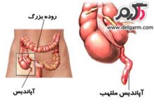 مراقبت های تغذیه ای بعد از عمل آپاندیس (2 نکته مهم)