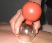 همه چیز درباره حجامت (2 نکته مهم)