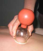 همه چیز درباره حجامت (2 نکته مهم)