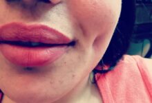 چال گونه (چال لپ با نخ) چگونه ایجاد می شود؟ (2 نکته مهم)