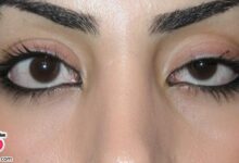 چرا دچار افتادگی پلک میشویم؟به همراه راهکارهای درمان افتادگی چشم+تصاویر و فیلم (2 نکته مهم)