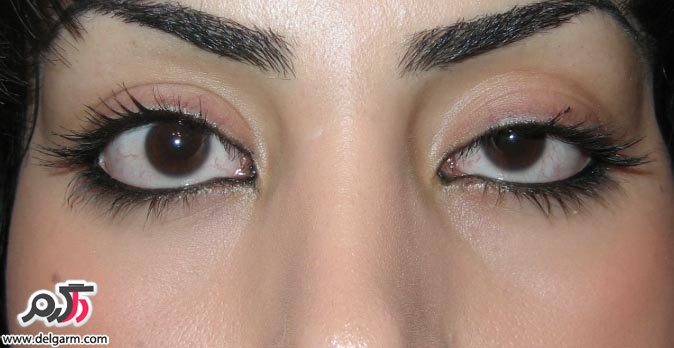 چرا دچار افتادگی پلک میشویم؟به همراه راهکارهای درمان افتادگی چشم+تصاویر و فیلم (2 نکته مهم)