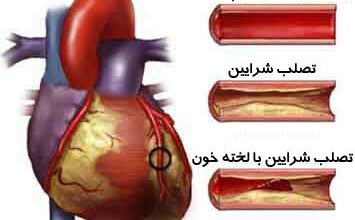 چربی هایی که برای قلب مفیدند (2 نکته مهم)
